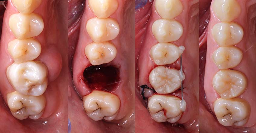 Autotransplantes Dentales y Cirugía Endodóntica