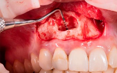 Autotransplantes Dentales y Cirugía Endodóntica