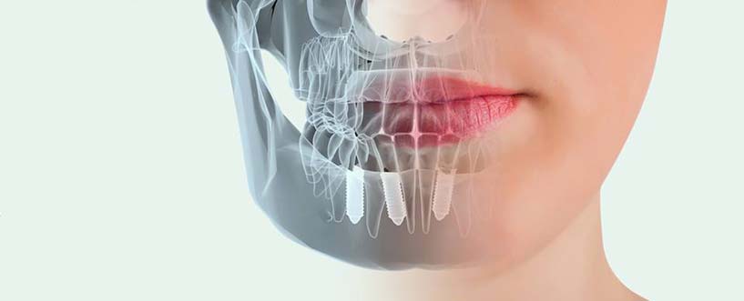No todos los implantes dentales son iguales