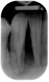 Regeneración periodontal