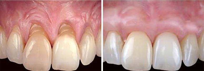 recesion gingival