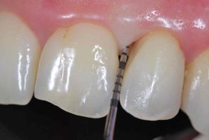 periodontitis tratamiento
