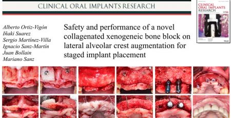 La prestigiosa revista Clinical Oral Implants Research publica un nuevo artículo en el que participan los Dres. Ortiz-Vigón y Suárez