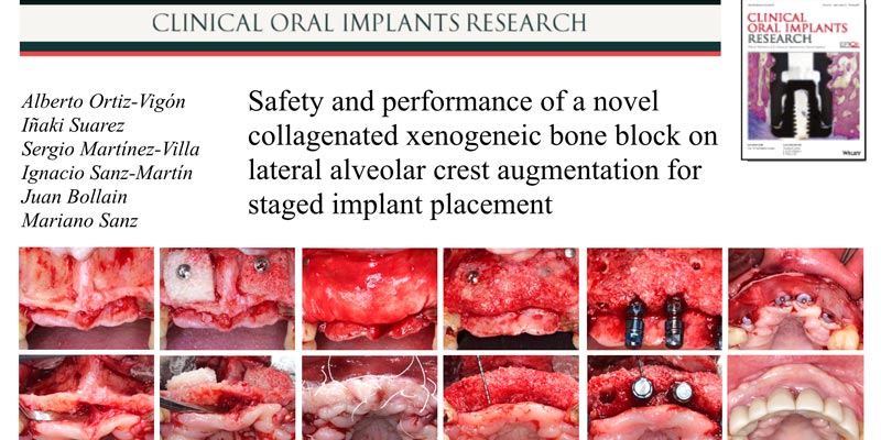 La prestigiosa revista Clinical Oral Implants Research publica un nuevo artículo en el que participan los Dres. Ortiz-Vigón y Suárez