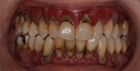 Relación entre la periodontitis y el cáncer gastrointestinal