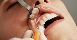 caries y periodontitis
