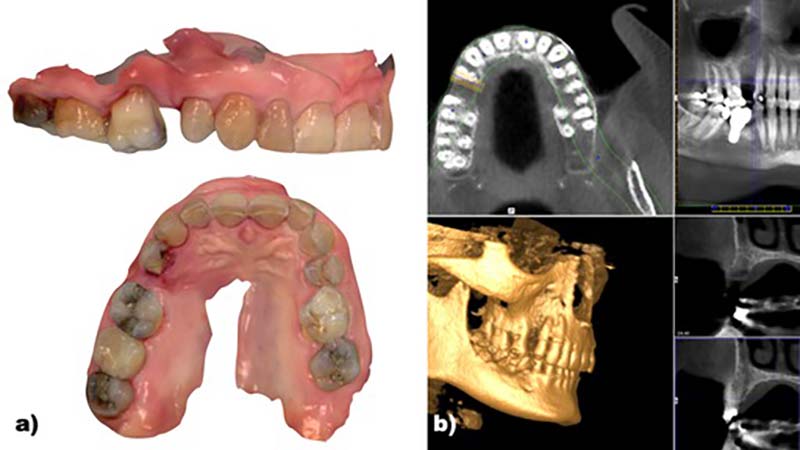Planificación digital y cirugía guiada para la restauración de pacientes con necesidad de implantes dentales
