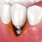 Explicación descriptiva de criterios para decidir cuándo puede colocarse un implante en pacientes con periodontitis