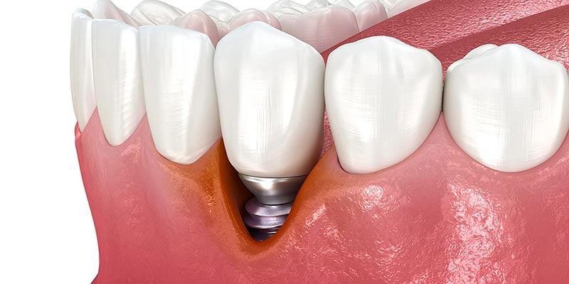 Explicación descriptiva de criterios para decidir cuándo puede colocarse un implante en pacientes con periodontitis