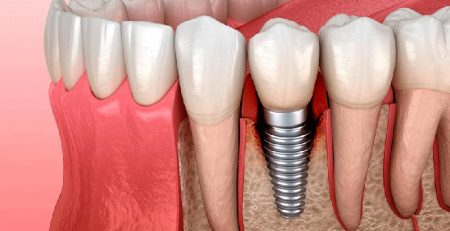 Periodoncia y por que es imprescindible antes de colocar implantes