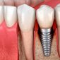 Periodoncia y por que es imprescindible antes de colocar implantes