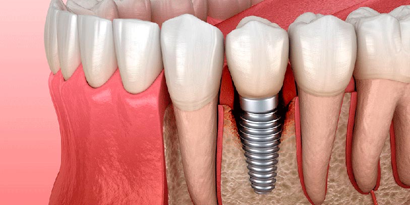 Periodoncia y por que es imprescindible antes de colocar implantes