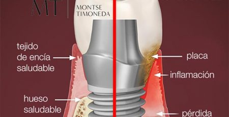Principales síntomas de la enfermedad periodontal y su impacto en los implantes