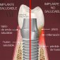 Principales síntomas de la enfermedad periodontal y su impacto en los implantes