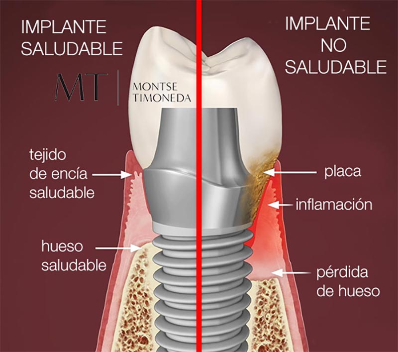 Principales síntomas de la enfermedad periodontal y su impacto en los implantes