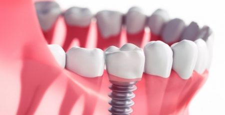 Mitos sobre los implantes dentales y la salud de la encías
