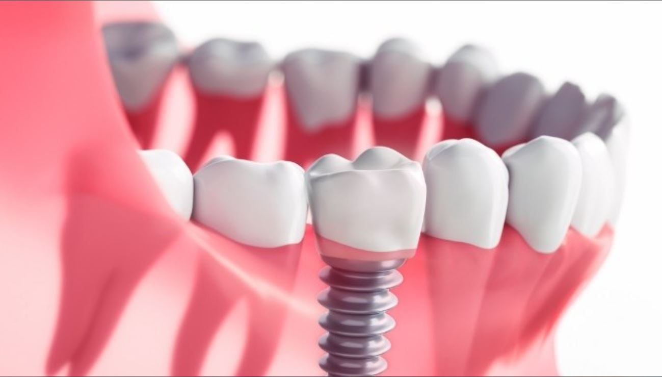 Mitos sobre los implantes dentales y la salud de la encías