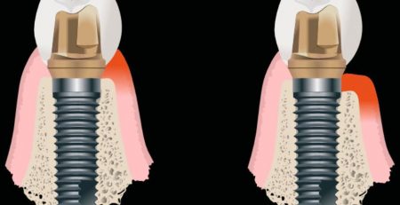 Cómo detectar complicaciones tempranas: mucositis y periimplantitis