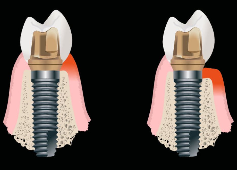 Cómo detectar complicaciones tempranas: mucositis y periimplantitis