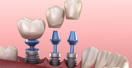 Implante inmediato o diferido