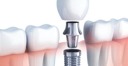 Preguntas frecuentes de pacientes antes de colocar un implante
