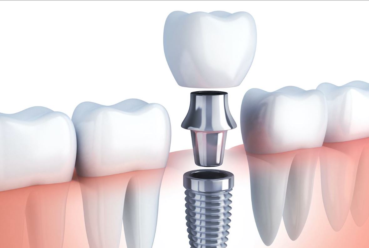Preguntas frecuentes de pacientes antes de colocar un implante