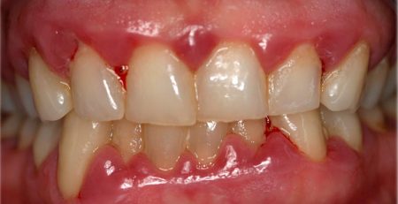 Encías Sangrantes: Causas, diagnóstico y cuando acudir al periodoncista