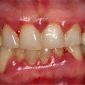 Encías Sangrantes: Causas, diagnóstico y cuando acudir al periodoncista