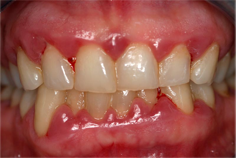Encías Sangrantes: Causas, diagnóstico y cuando acudir al periodoncista