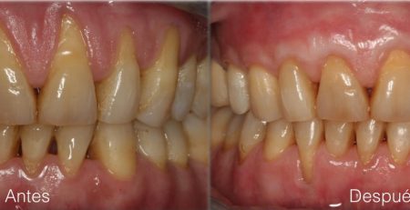 Recesión gingival