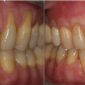 Recesión gingival