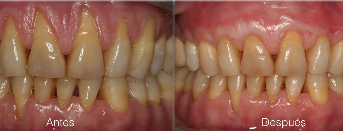 Recesión gingival